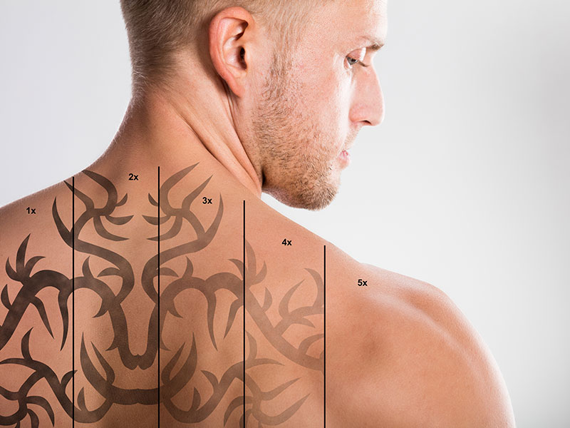 Laser Tattoo Removal Steps